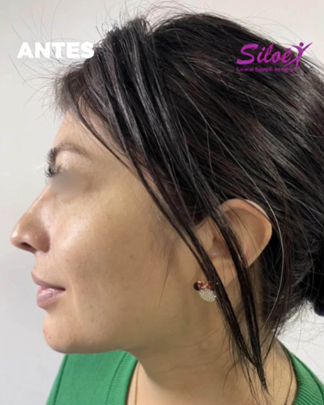 Antes del tratamiento de ácido hialurónico